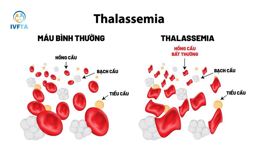 Hình ảnh hồng cầu bất thường khi bị Bệnh Thalassemia