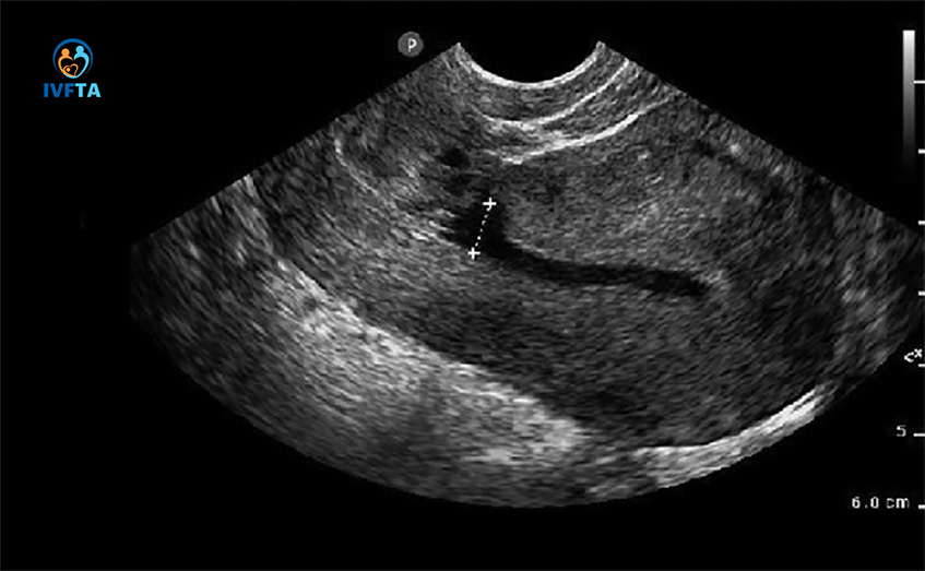 Hình ảnh khiếm khuyết sẹo mổ lấy thai bằng siêu âm 2D Hình ảnh khiếm khuyết sẹo mổ lấy thai bằng siêu âm 2D