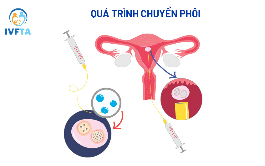 Chuyển phôi có đau không là câu hỏi mà nhiều cặp vợ chồng thực hiện thụ thai trong ống nghiệm lo lắng