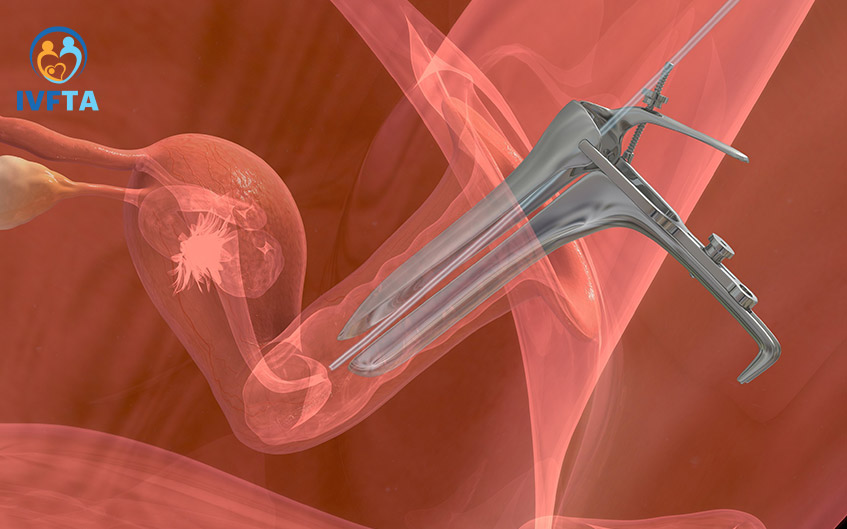 Quá trình chuyển phôi không gây đau đớn như nhiều người lầm tưởng