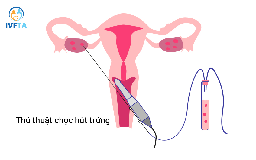 Thuốc gây tê hoặc gây mê là yếu tố trong chọc hút trứng ảnh hưởng sức khỏe Thuốc gây tê hoặc gây mê là yếu tố trong chọc hút trứng ảnh hưởng sức khỏe