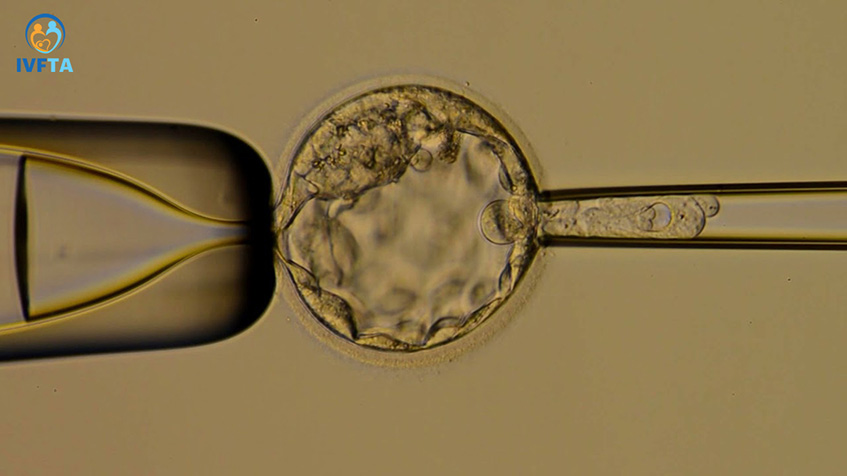Phôi nang sẽ được lấy từ 5-10 tế bào để thực hiện sàng lọc phôi