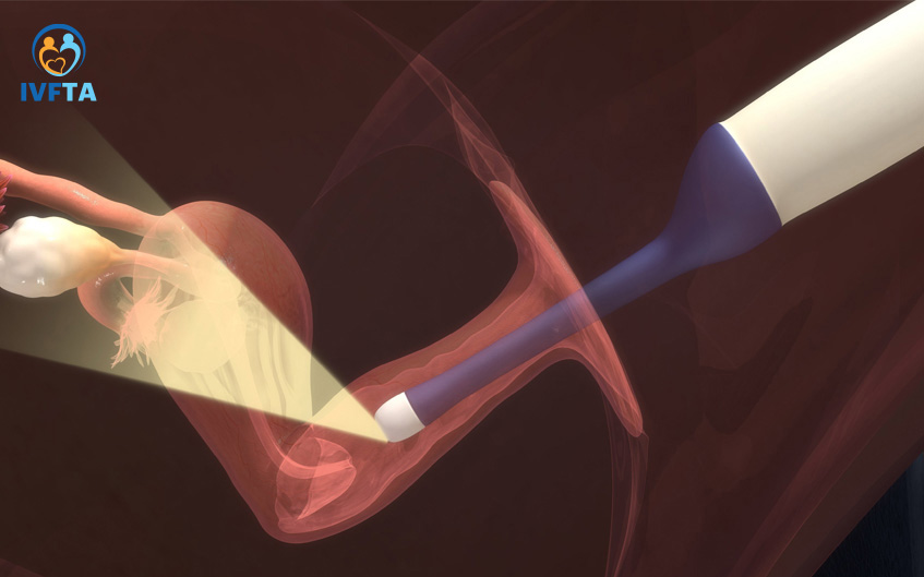 Các hormone hỗ trợ sinh sản trong chọc hút trứng có thể ảnh hưởng sức khoẻ tâm lý phụ nữ Các hormone hỗ trợ sinh sản trong chọc hút trứng có thể ảnh hưởng sức khoẻ tâm lý phụ nữ