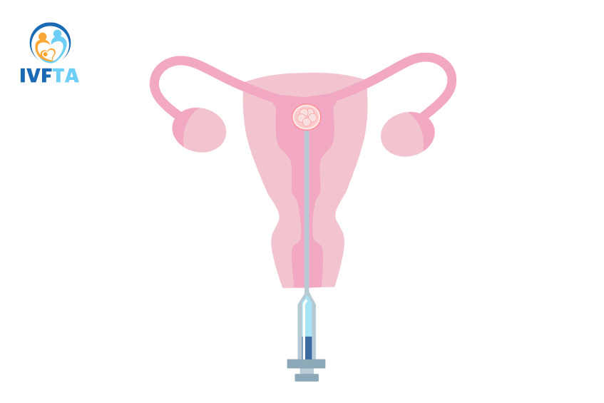 Quá trình chuyển phôi tươi IVF thường diễn ra vào ngày 3 hoặc 5 sau chọc hút trứng