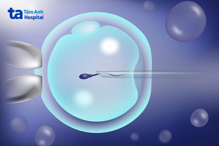 chuyển phôi khảm cần được tư vấn kỹ lưỡng