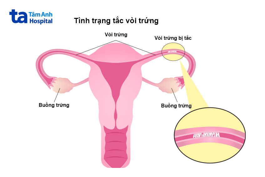 hiện tượng tắc vòi trứng và chu kỳ kinh hiện tượng tắc vòi trứng và chu kỳ kinh