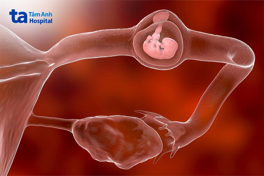biến chứng nguy hiểm của tắc vòi trứng biến chứng nguy hiểm của tắc vòi trứng