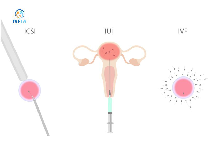 Nam giới tinh trùng yếu nên làm IUI hay IVF còn phụ thuộc vào nhiều yếu tố Nam giới tinh trùng yếu nên làm IUI hay IVF còn phụ thuộc vào nhiều yếu tố
