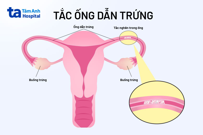 tắc vòi trứng có thể điều trị được nếu phát hiện sớm tắc vòi trứng có thể điều trị được nếu phát hiện sớm