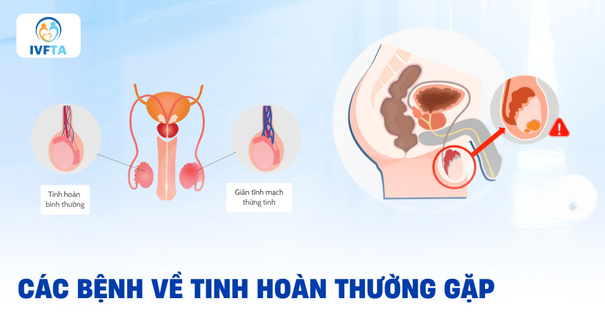 Các bệnh về tinh hoàn thường gặp