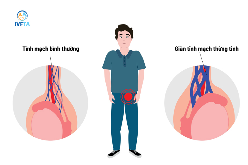 Giãn tĩnh mạch thừng tinh gây nên nhiều biến chứng sức khỏe sinh sản ở nam giới