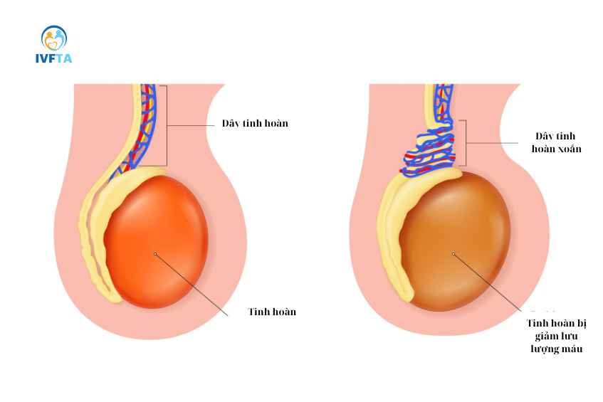 Hình ảnh minh họa tinh hoàn bị xoắn (bên phải) làm giảm lưu lượng máu xuống tinh hoàn