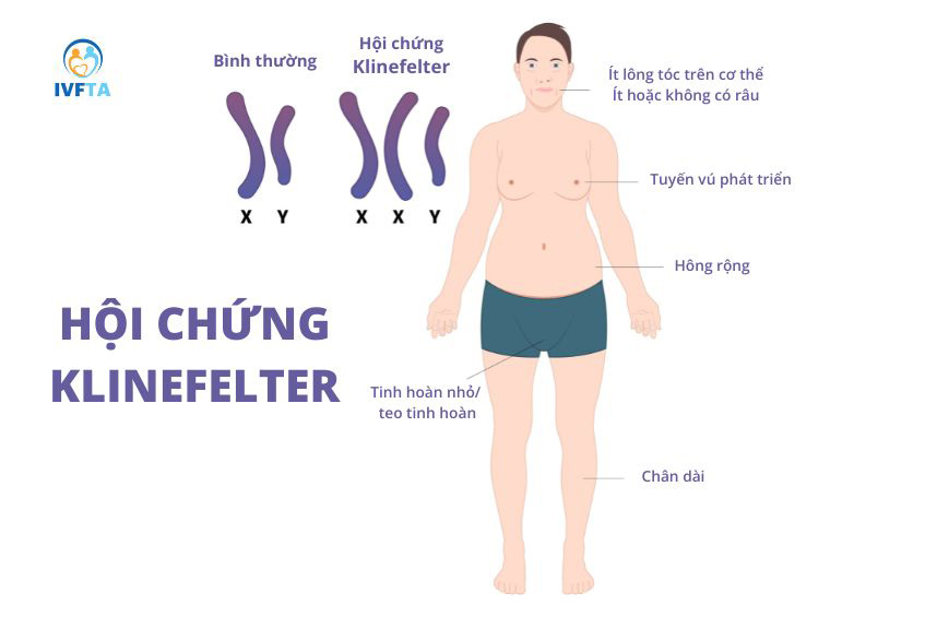 Nam giới mắc hội chứng Klinefelter có thể có con chính chủ nhờ kỹ thuật micro-TESE
