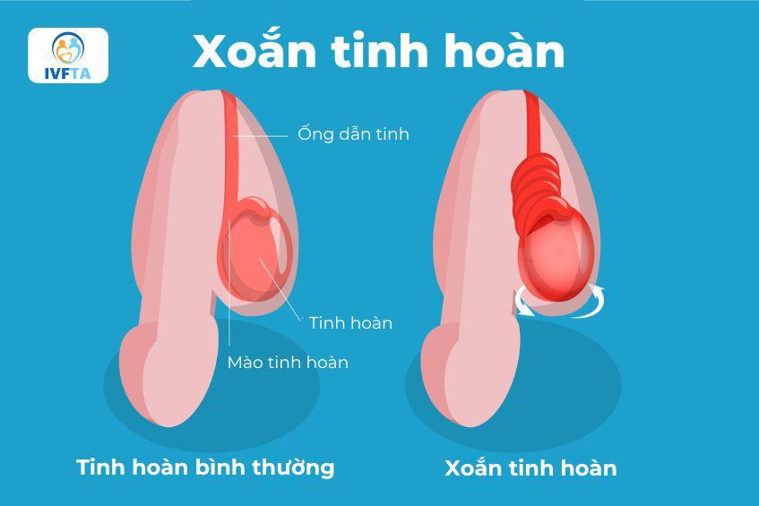 Tinh hoàn lạc chỗ nếu không được điều trị sớm có thể dẫn tới biến chứng xoắn tinh hoàn