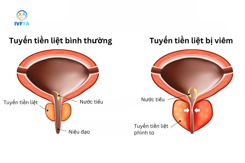 Viêm tuyến tiền liệt là bệnh nam khoa phổ biến ở nam giới gây ra tình trạng đau rát khi tiểu