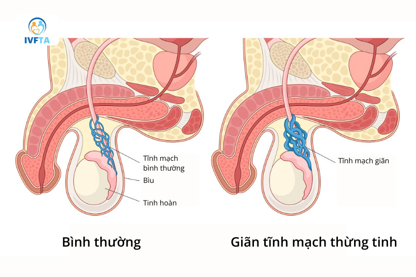 Giãn tĩnh mạch thừng tinh là bệnh lý nam khoa phổ biến, ảnh hưởng đến khả năng sinh sản nam