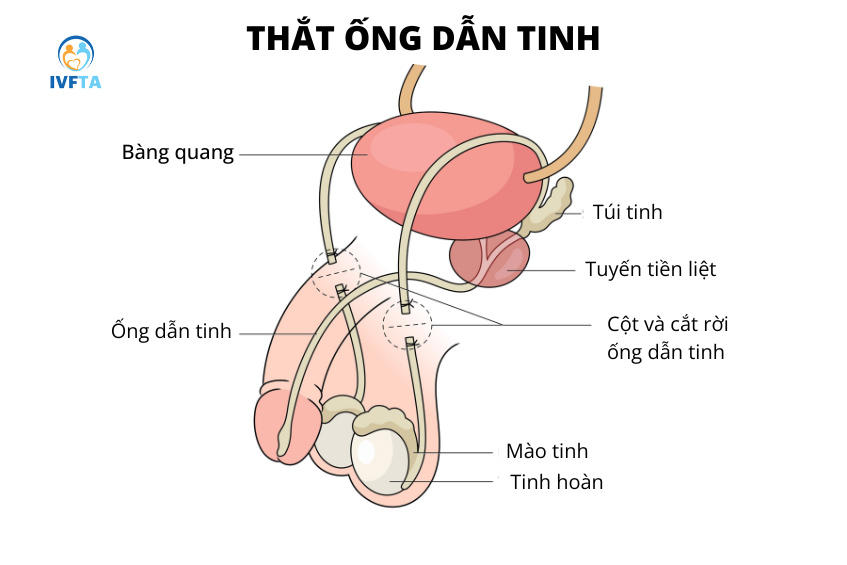 Nam giới thực hiện phẫu thuật thắt ống dẫn tinh là một trong những nguyên nhân gây hiếm muộn