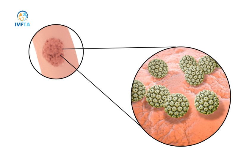 Sùi mào gà là bệnh lây truyền qua đường tình dục xuất hiện ở cả nam và nữ Sùi mào gà là bệnh lây truyền qua đường tình dục xuất hiện ở cả nam và nữ
