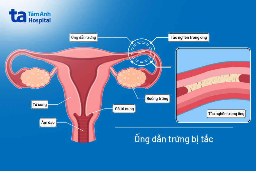 tắc ống dẫn trứng gây vô sinh ở nữ