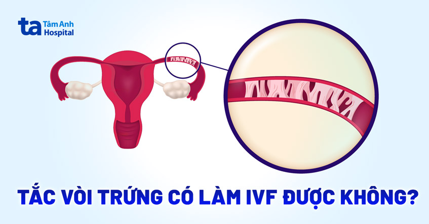 tắc vòi trứng có làm ivf được không