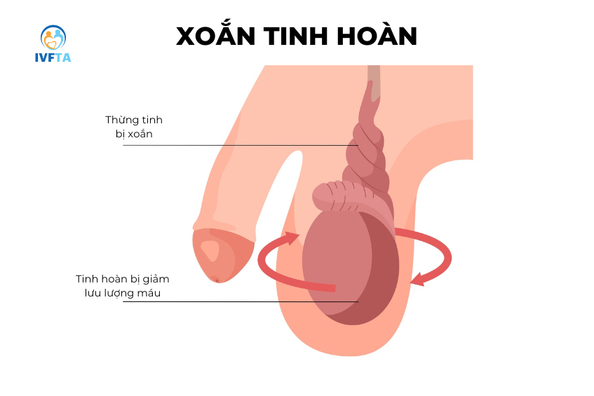 Xoắn tinh hoàn 1 bên sẽ không gây vô sinh nhưng khả năng sinh sản sẽ suy giảm đáng kể