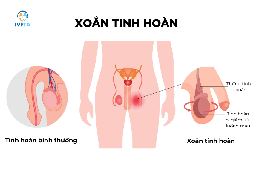 Tình trạng xoắn tinh hoàn khiến các búi tĩnh mạch tinh bị xoắn lại gây tắc nghẽn lưu lượng máu đến nuôi tinh hoàn
