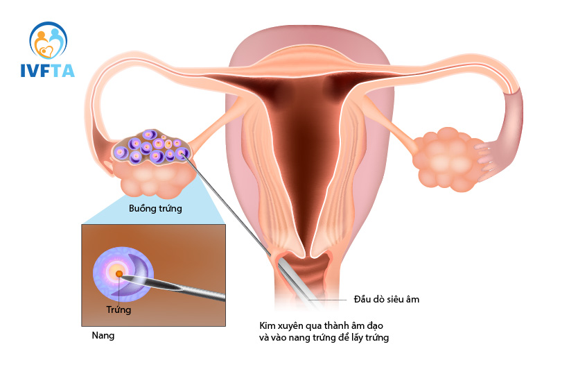 Hiến trứng không ảnh hưởng đến khả năng sinh sản sau này nếu thực hiện đúng quy trình Hiến trứng không ảnh hưởng đến khả năng sinh sản sau này nếu thực hiện đúng quy trình