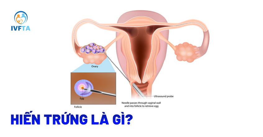 Hiến trứng là gì?