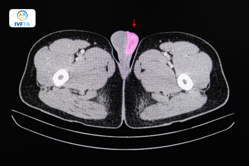Minh họa hình ảnh chụp CT ung thư tinh hoàn