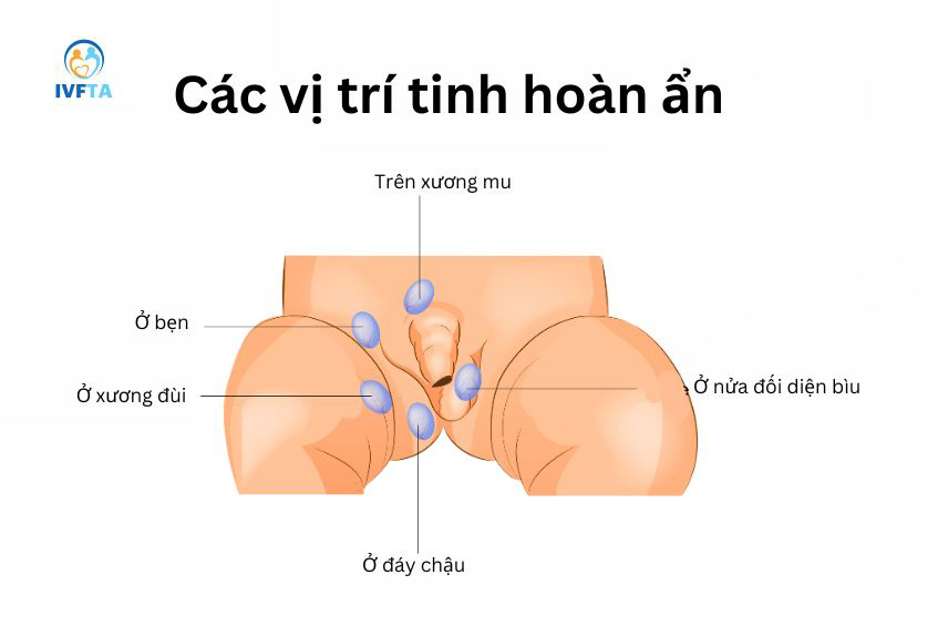 Tinh hoàn ẩn là yếu tố nguy cơ cao làm xuất hiện u tinh hoàn ác tính