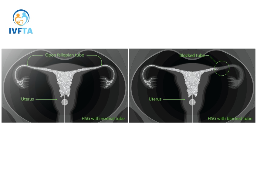Chụp MRI giúp đánh giá sâu các vấn đề liên quan tử cung vòi trứng