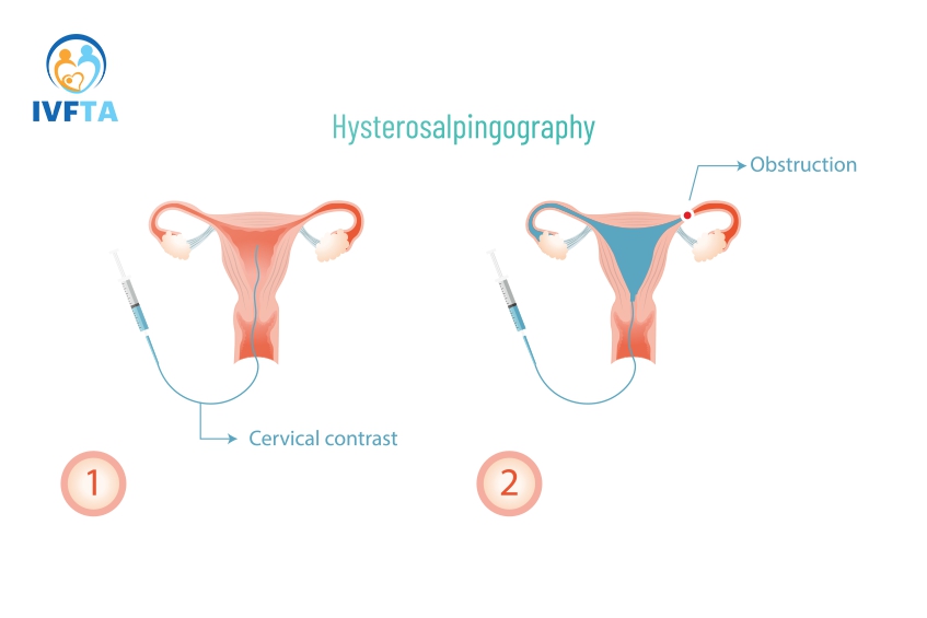 Kết quả chụp X-quang tử cung vòi trứng được xem là cơ sở để chẩn đoán vô sinh nữ