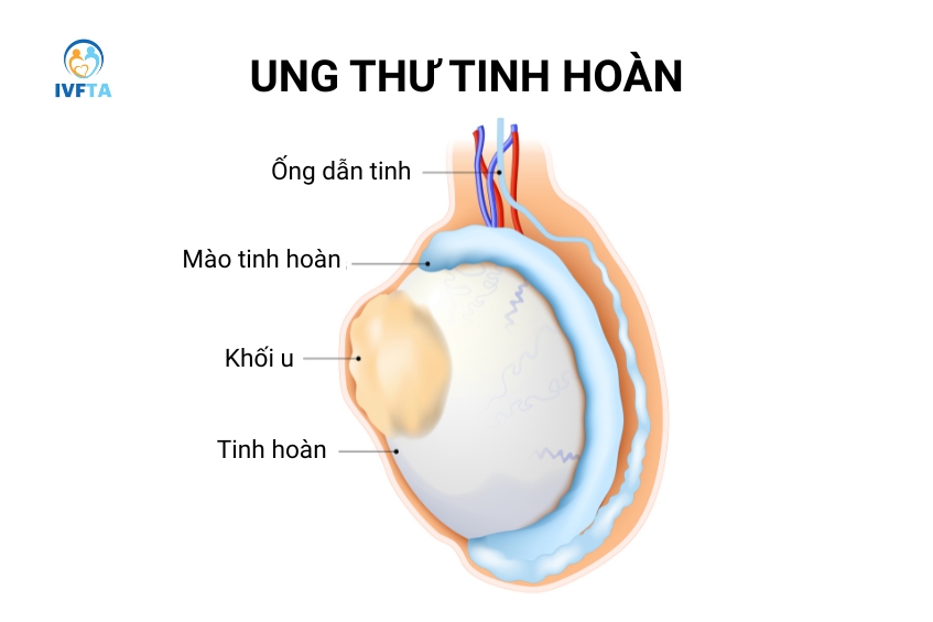 Khối u hoặc cục cứng xuất hiện bất thường ở tinh hoàn có thể gợi ý tình trạng ung thư tinh hoàn