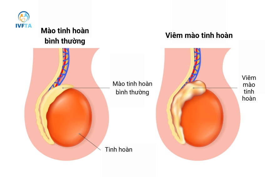Nam giới mắc bệnh lây truyền qua đường tình dục có nguy cơ cao bị viêm mào tinh Nam giới mắc bệnh lây truyền qua đường tình dục có nguy cơ cao bị viêm mào tinh