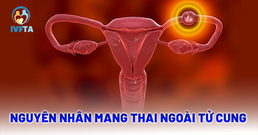 Mang thai ngoài tử cung: Nguyên nhân, phòng ngừa