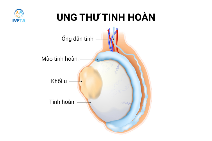 Nổi cục cứng ở dưới tinh hoàn có thể gợi ý tình trạng ung thư tinh hoàn