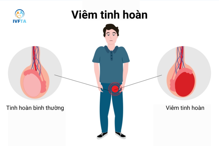 Viêm tinh hoàn là một trong những nguyên nhân phổ biến có thể gây áp xe bìu