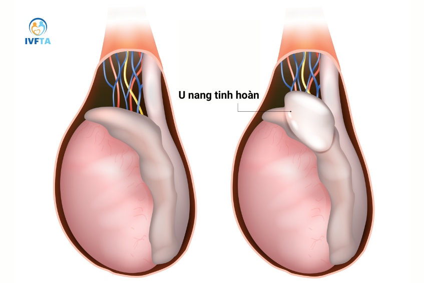 Phần lớn các trường hợp u nang ở tinh hoàn là lành tính Phần lớn các trường hợp u nang ở tinh hoàn là lành tính