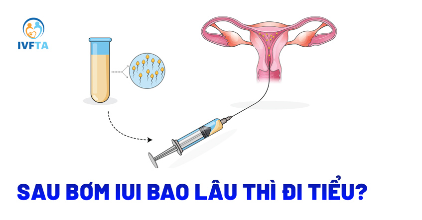 Sau bơm IUI bao lâu thì đi tiểu?
