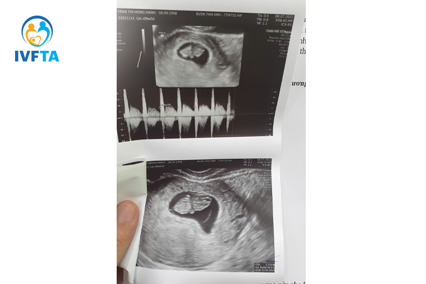 hình ảnh siêu âm của mẹ hồng hạnh