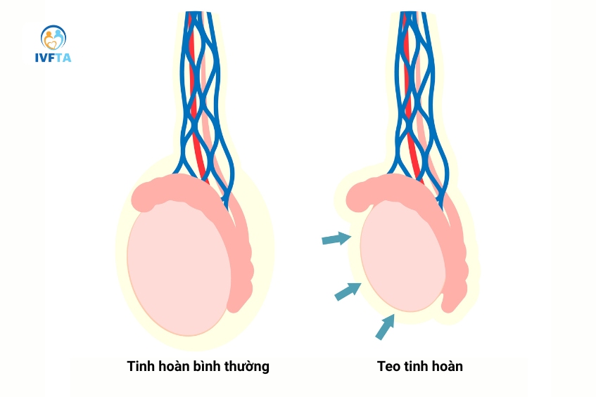 Biến chứng viêm tinh hoàn có thể gây teo tinh hoàn làm ảnh hưởng khả năng sinh sản nam giới