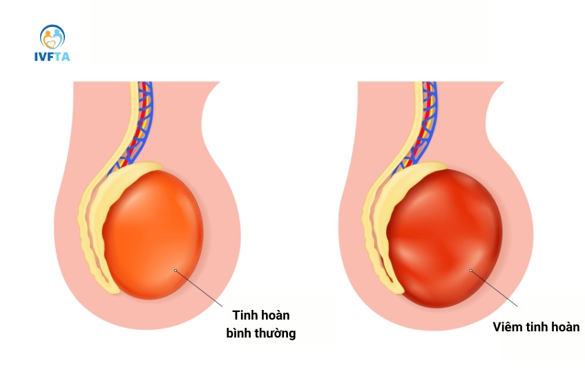 Tinh hoàn bị viêm nếu không được điều trị đúng cách có thể dẫn đến nhiều biến chứng nguy hiểm