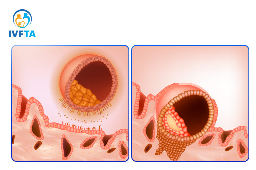 Cần tránh tác động mạnh trong giai đoạn phôi thai làm tổ trong tử cung