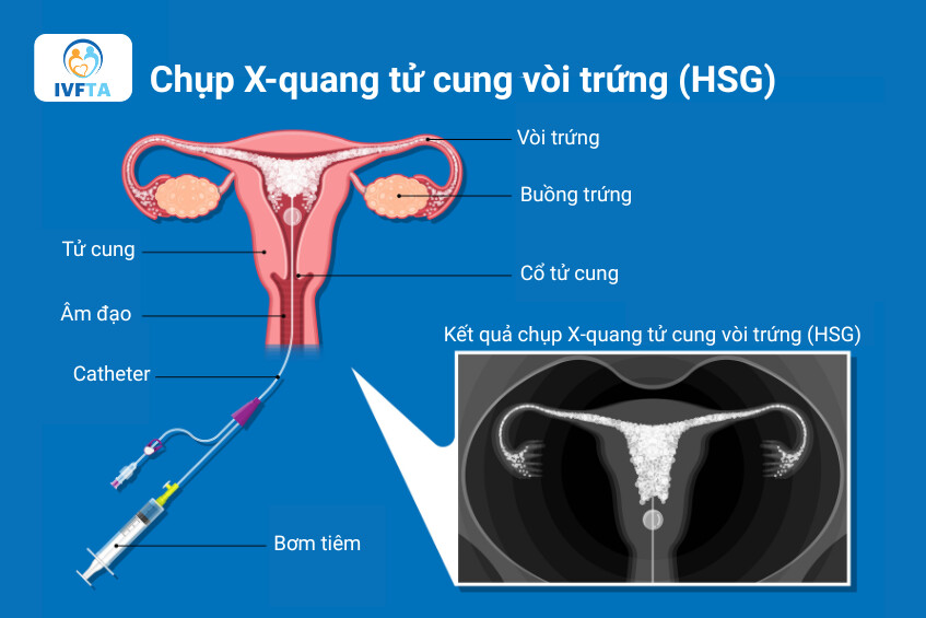 Chụp HSG giúp kiểm tra cấu trúc bên trong tử cung và sự thông thoáng của hai vòi trứng Chụp HSG giúp kiểm tra cấu trúc bên trong tử cung và sự thông thoáng của hai vòi trứng