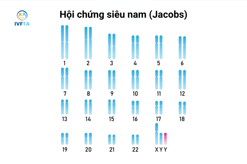 Hội chứng siêu nam (Jacobs) là bất thường nhiễm sắc thể khi có thừa một nhiễm sắc thể Y trong bộ gen