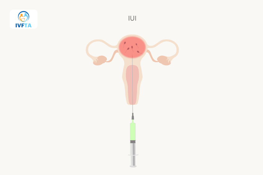 IUI có ưu điểm ít xâm lấn, đơn giản và chi phí ít hơn so với các phương pháp khác IUI có ưu điểm ít xâm lấn, đơn giản và chi phí ít hơn so với các phương pháp khác