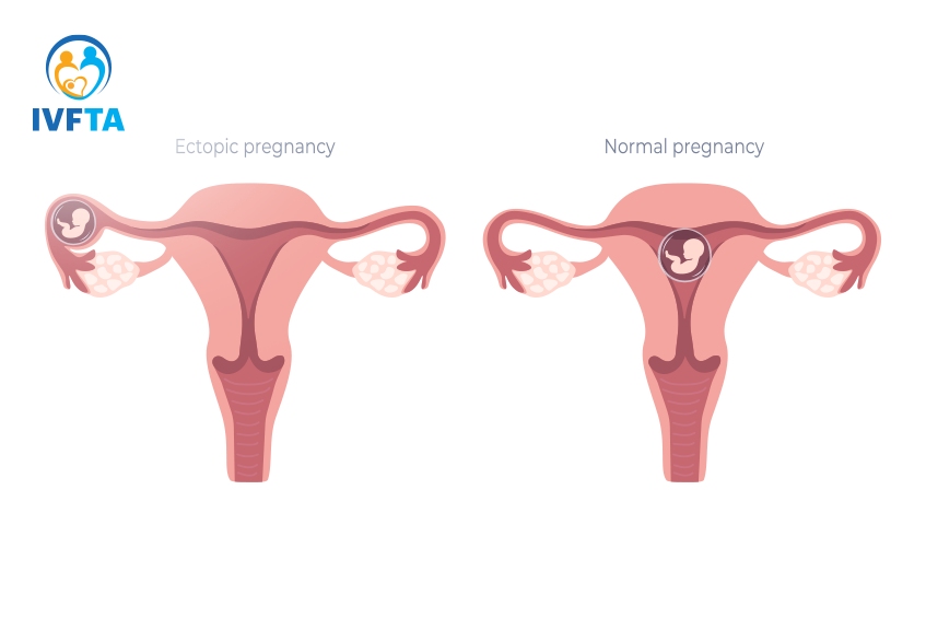 Thai bám sẹo mổ lấy thai được xem là một dạng thai ngoài tử cung hiếm gặp