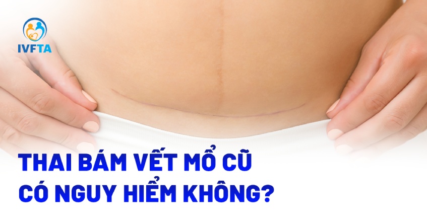 Thai bám vết mổ cũ lấy thai có nguy hiểm không?