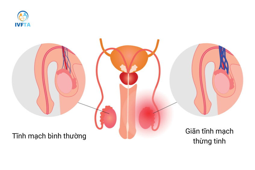 Giãn tĩnh mạch thừng tinh là một trong những nguyên nhân phổ biến gây ở một trong hai bên tinh hoàn