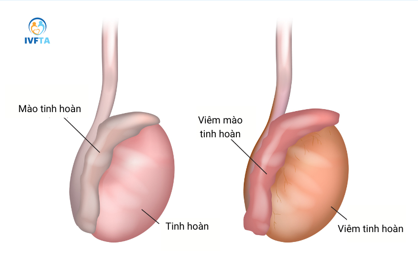 Tinh hoàn và mào tinh xuất hiện viêm nhiễm là những nguyên nhân phổ biến gây đau